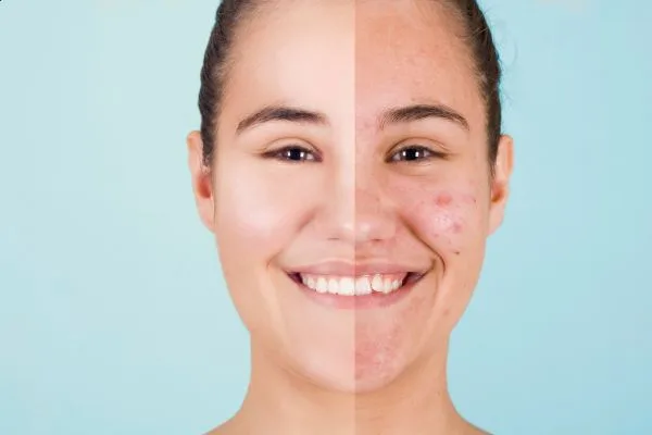 טיפול באקנה בירושלים