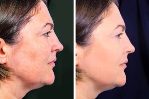 טיפול באקנה לפני ואחרי